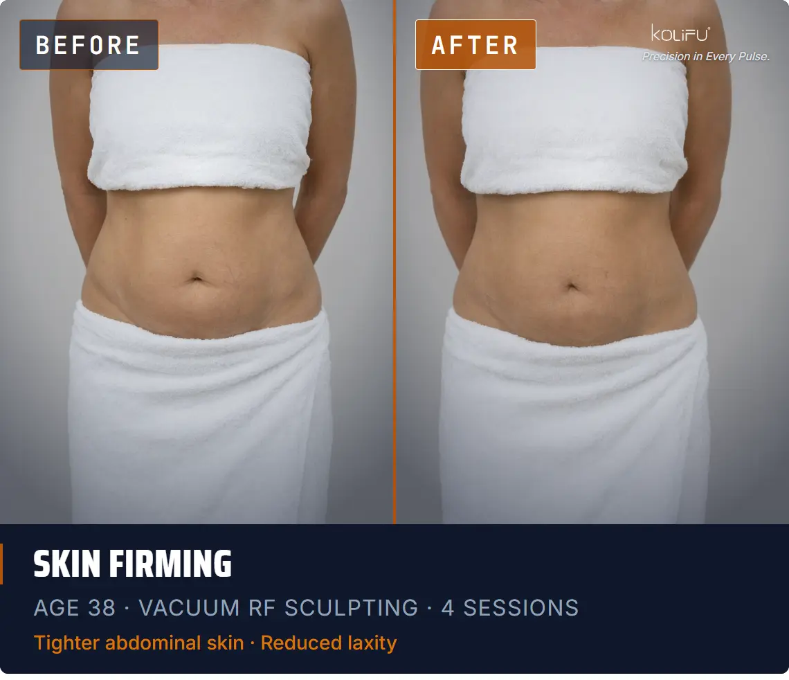 VACUUM RF SCULPTING antes y después