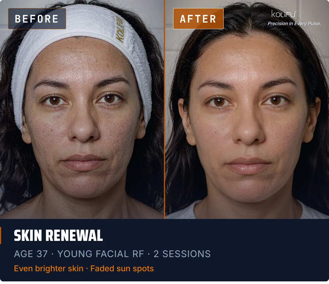YOUNG FACIAL RF antes y después