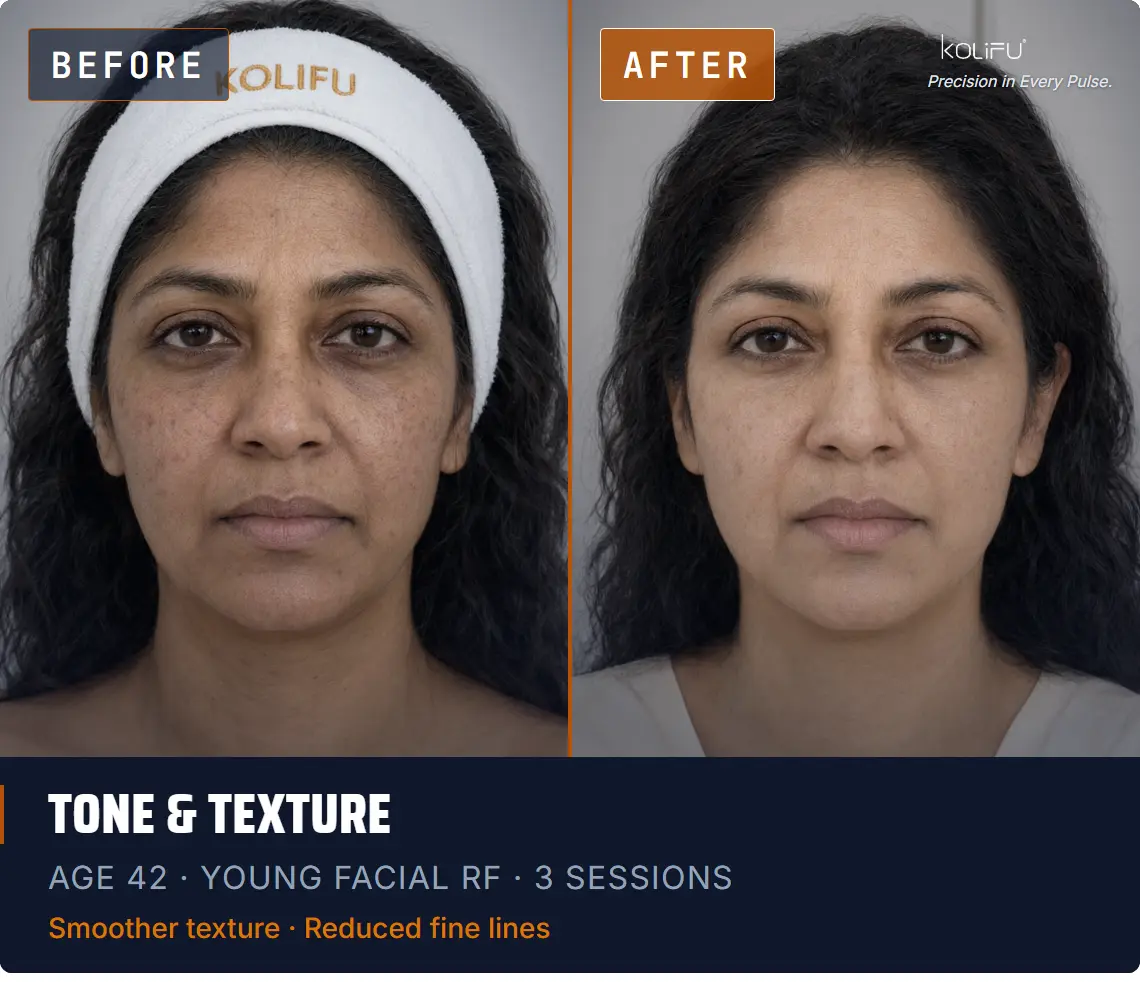 YOUNG FACIAL RF antes y después