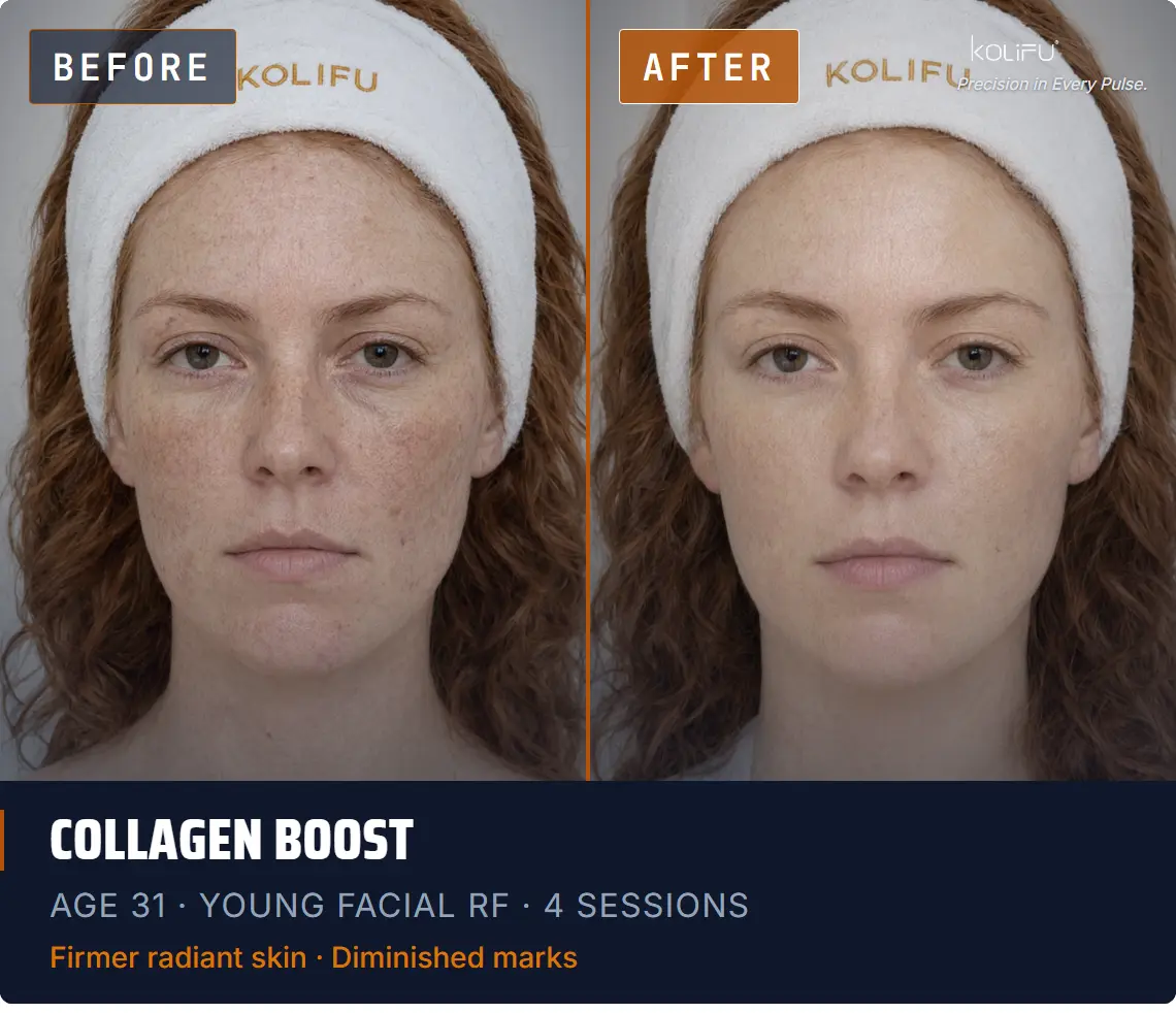 YOUNG FACIAL RF antes y después