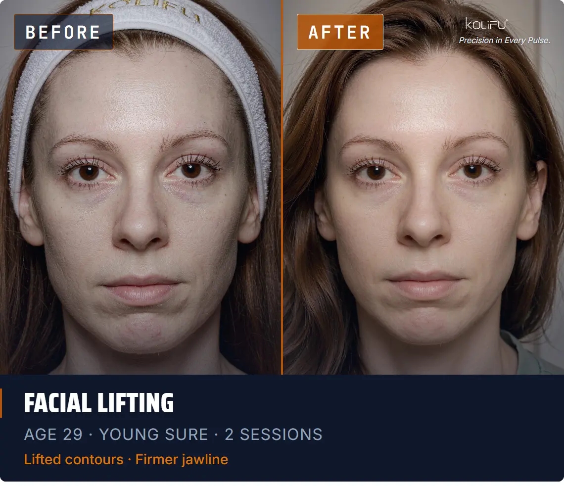 YOUNG SURE antes y después