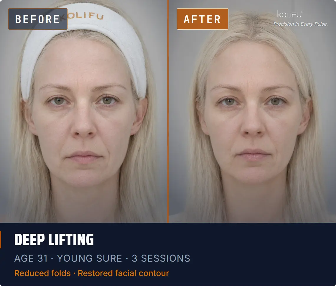 YOUNG SURE antes y después